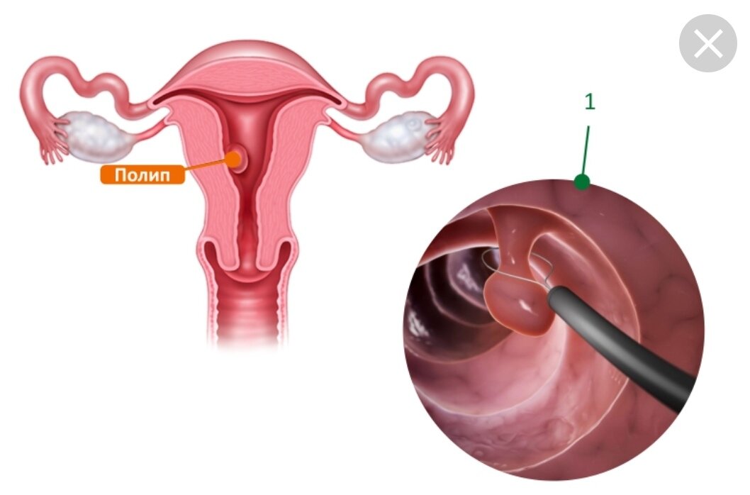 Полипы в матке причины. Гистероскопия полипэктомия. Полипэктомия шейки матки. Полип эндометрия гистеро. Полипэктомия матки выскабливание.