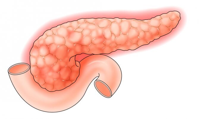 Хронический панкреатит