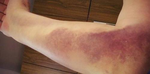 Федункив ушибла локоть