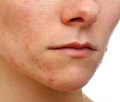 Фото: https://www.google.com/url?sa=i&url=https%3A%2F%2Fwww.provrach.ru%2Farticle%2F9437-kqqk-19-m11-25-akne-mkb-10&psig=AOvVaw0pv3ncRrHB_rHppDrg_WDO&ust=1595154482183000&source=images&cd=vfe&ved=0CAMQjB1qFwoTCIDcu9bL1uoCFQAAAAAdAAAAABAY