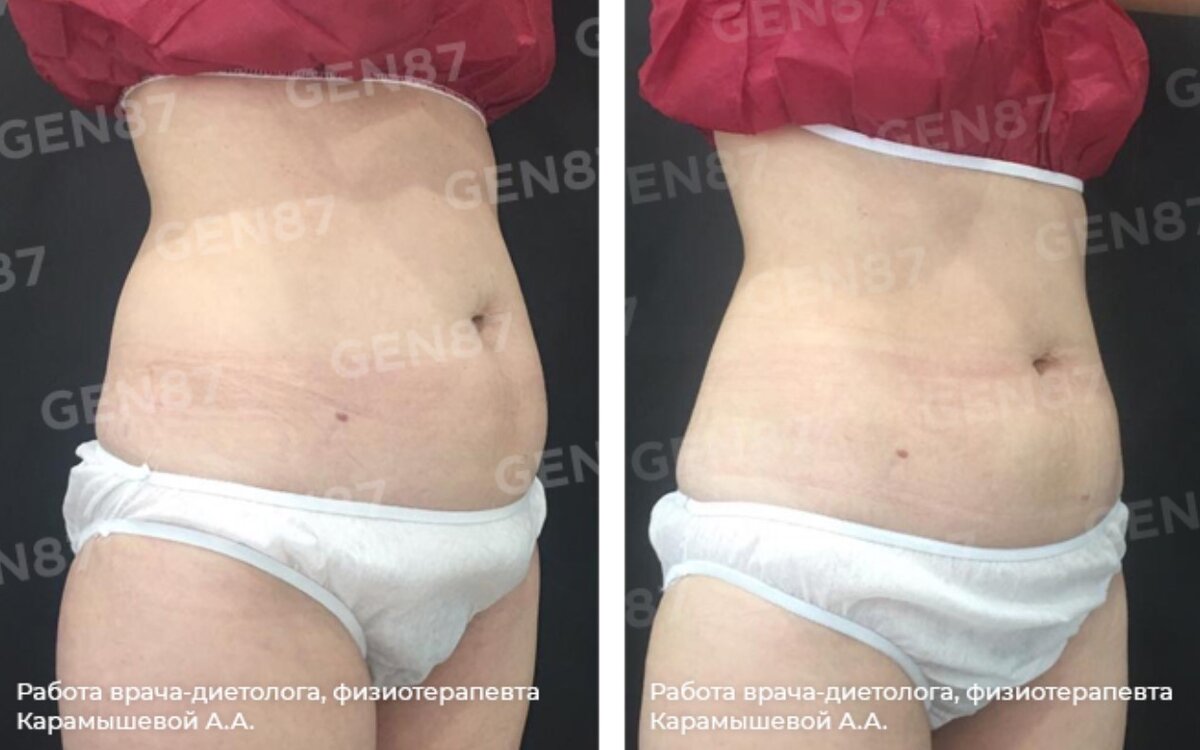 Фото до и после криолиполиза Clatuu в клинике GEN87