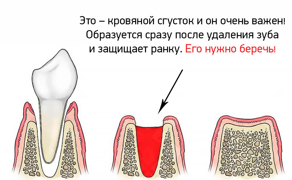 Что делать после удаления зуба