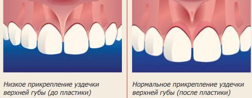 Уздечка верхней губы. Показания к пластике