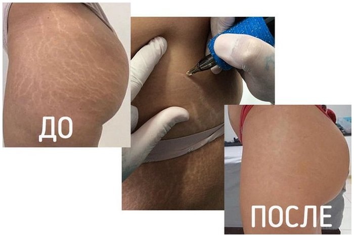 Камуфляж растяжек. 