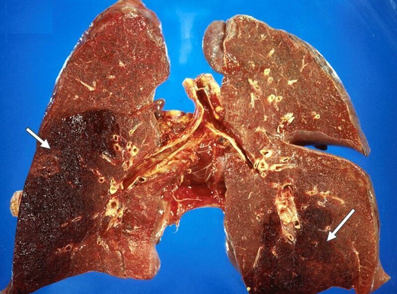 Инфаркт лёгкого. Изображение взято с сайта Министерство здравоохранения Российской Федерации (minzdrav.gov.ru)
