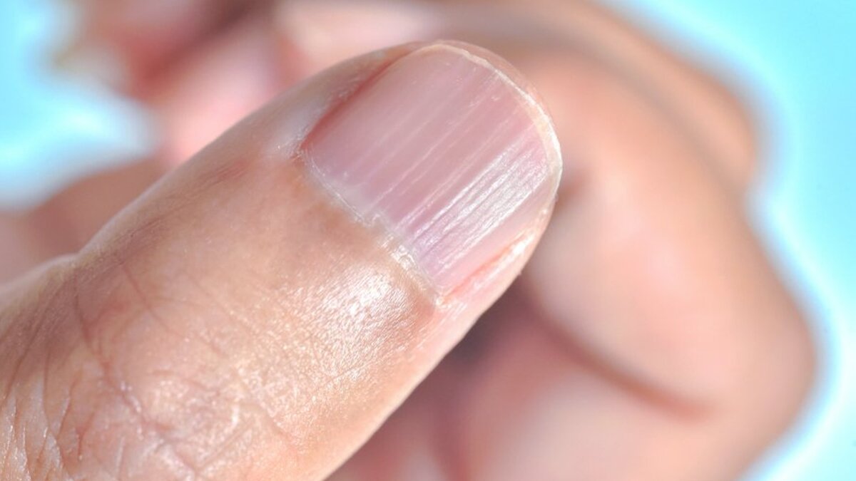 Ребристые ногти причина у мужчин. Поперечная исчерченность ногтей.