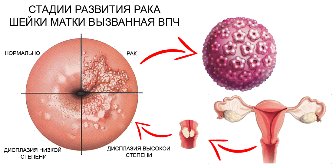 Впч рак шейки. Остроконечных кондилом и папиллом. Плоская кондилома шейки матки. Папилломавирус человека у женщин.