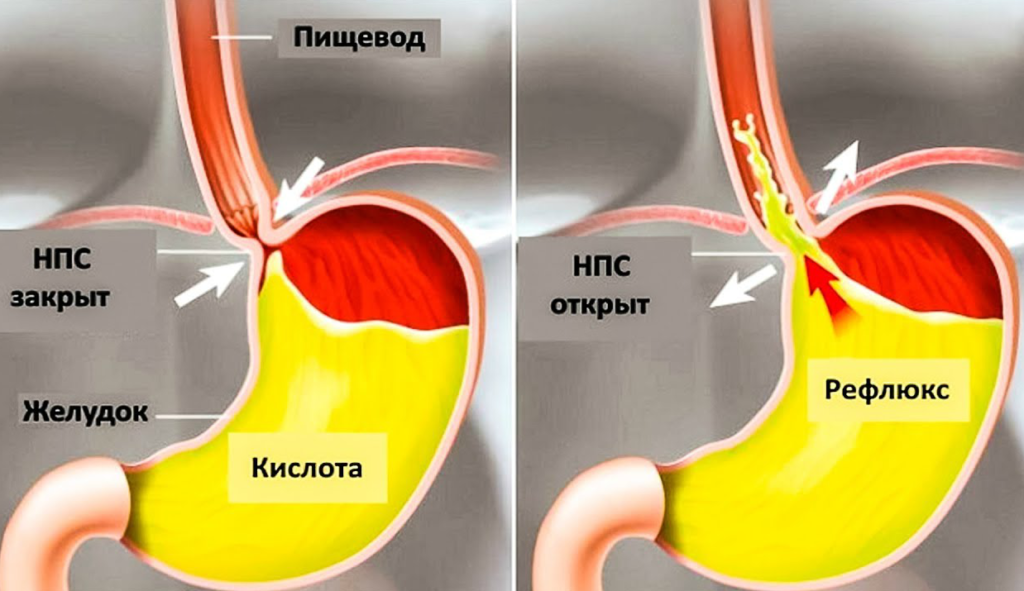 Выброс из желудка в горло ночью. Эзофагит рефлюкс кислотный. рефлекс эзофагит рефлюкс. кламан меж желудком и пищеводом. заброс содержимого желудка в пищевод.