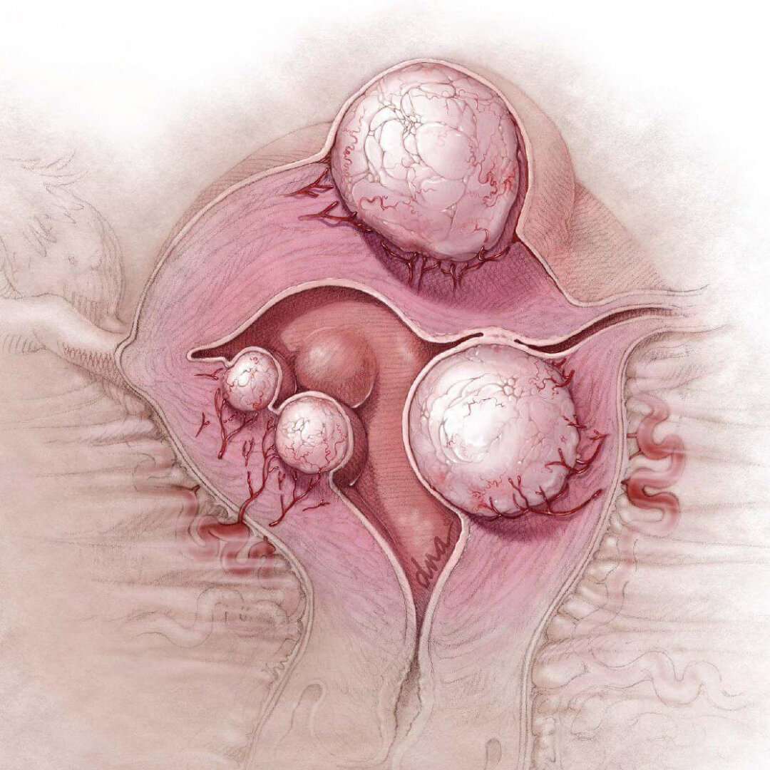 Миома в картинках