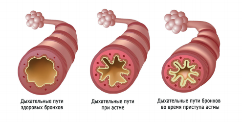 Просвет бронхов при бронхиальной астме.