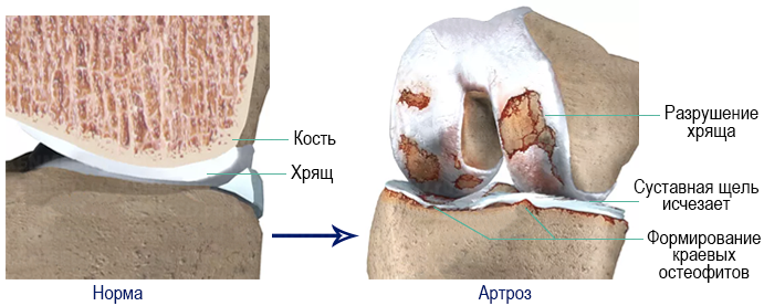 Лечение артроза коленного сустава (гонартроза)