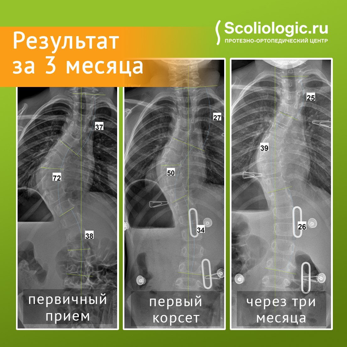 Лечение сколиоза у взрослых пациентов