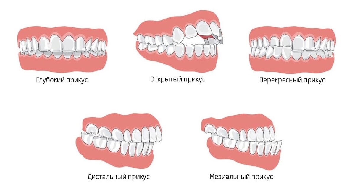 Виды неправильного прикуса