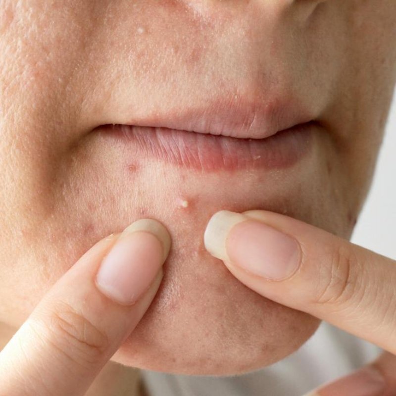 Как перестать давить прыщи на лице. Как перестать давить прыщи на лице. Выдавливливание прыщей. Как перестать давить прыщи на лице. Как перестать давить прыщи на лице.