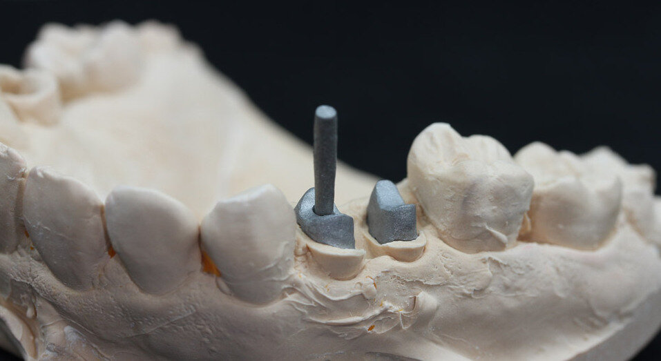 Зубная культевая вкладка под коронку: что это такое, виды культевых вкладок