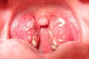 Дифтерия зева