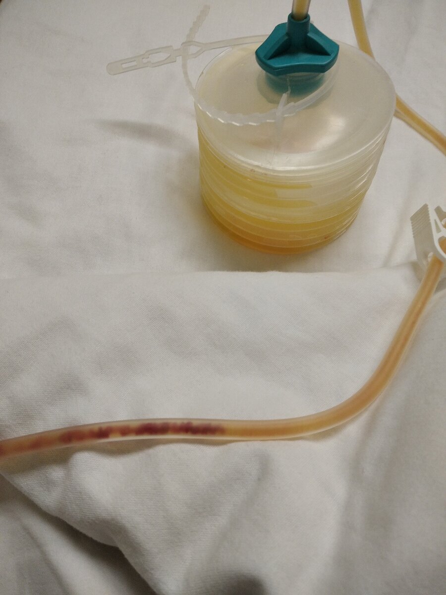 Я не чувствовала никаких неудобств, с таким дренажом