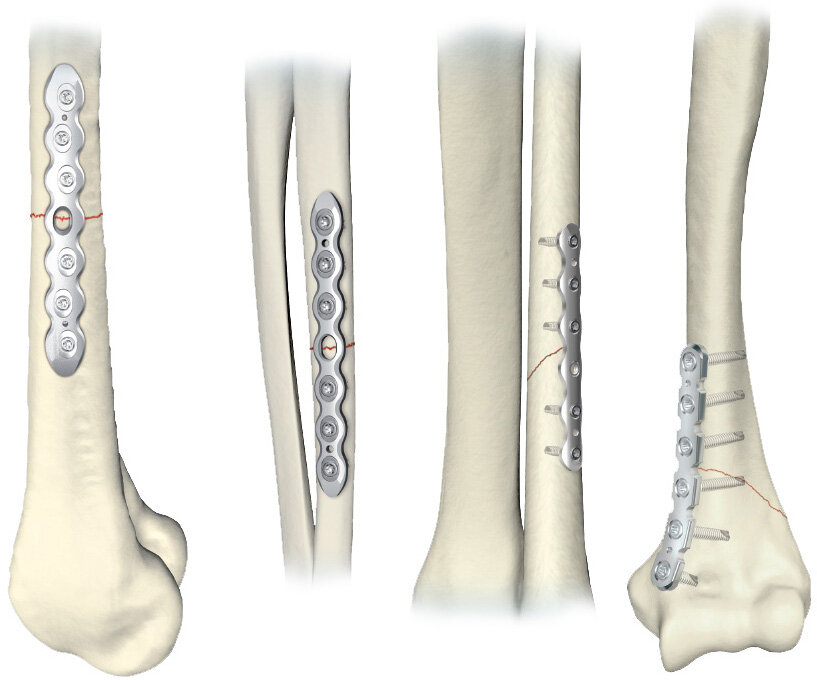 Использование стальных пластин при переломах