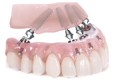 Протез All-on-4