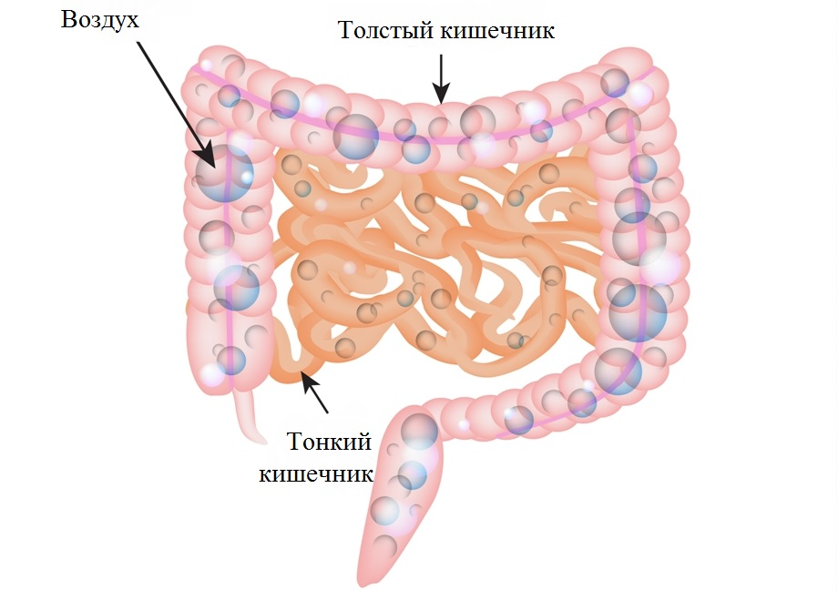 Почему в кишечнике много газов. Скопление газа в кишечнике. Пузырьки газа в кишечнике. Газовые пузырьки в кишечнике. Образование газов в кишечнике.