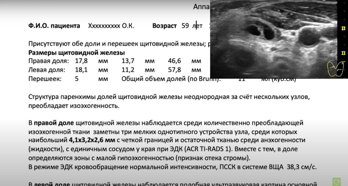 Ti rads обеих долей