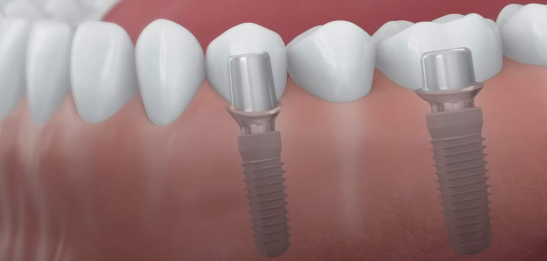 Зубной мост на имплантах (могут фиксировать на культе зуба, если он сохранен).
