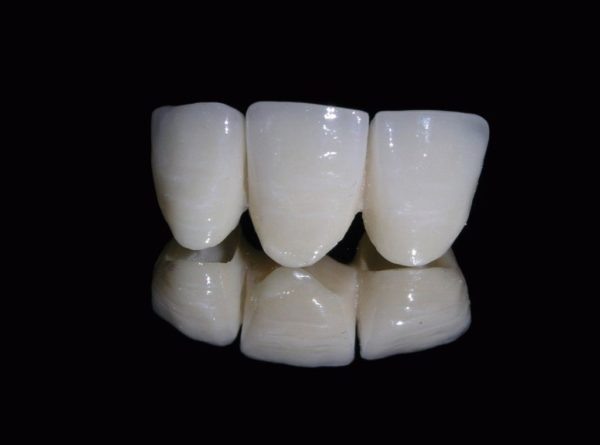 Как устанавливают керамические мосты