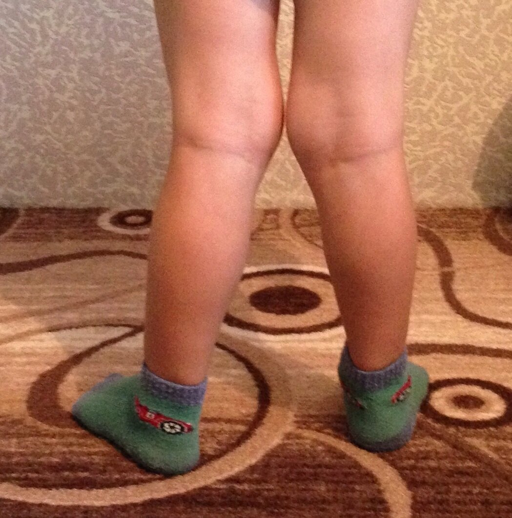 волосатые ноги у ребенка 3 года фото 3