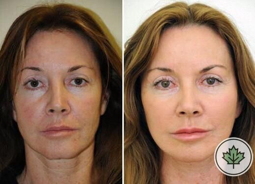 Результат народного омоложения. Подписывайтесь на канал и ставьте лайк!