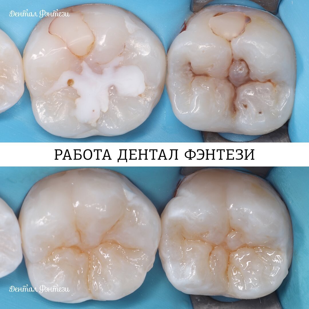 До и после лечения