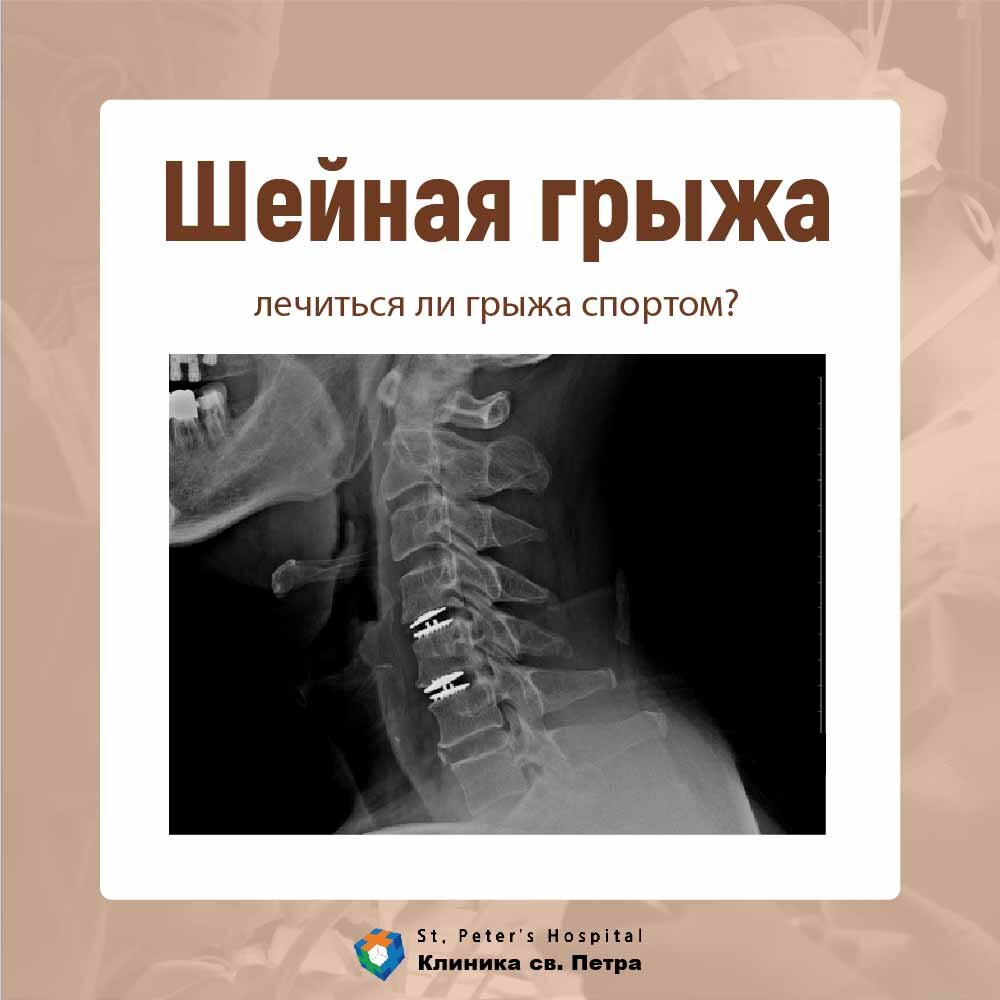 Лечение шейной грыжи отзывы. Грыжа шейного отдела мкб 10.