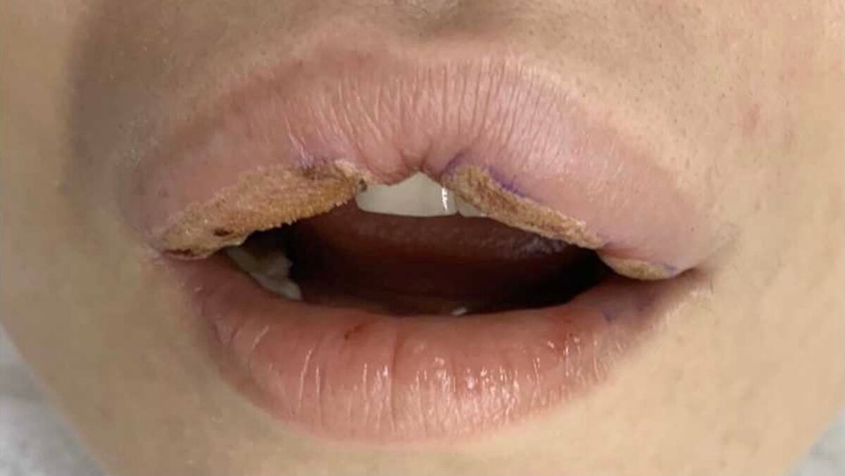    Последствия биополимерного геля. Фото: социальные сети