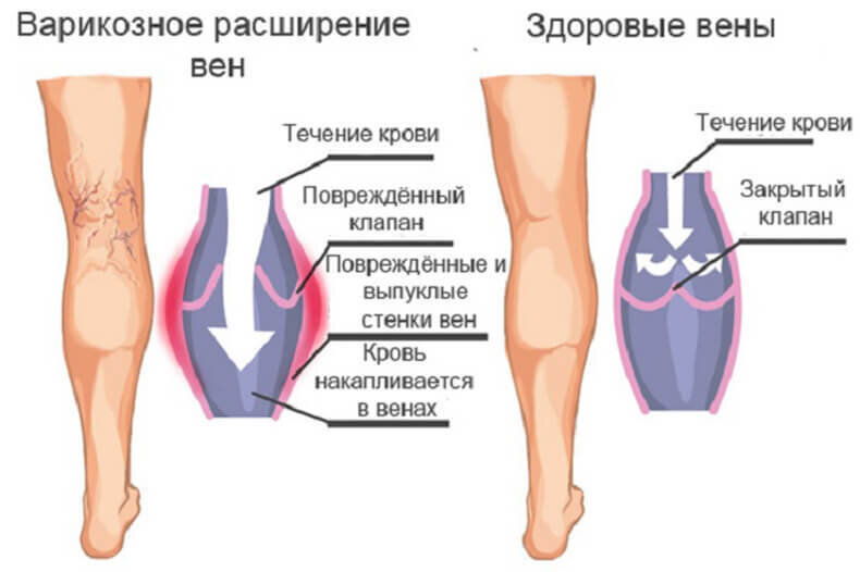Повреждение клапанов приводит к повышению объёма венозной крови протекающей по поверхностным венам, что приводит к растяжению их стенки.
