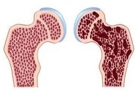 голова бедренной кости 