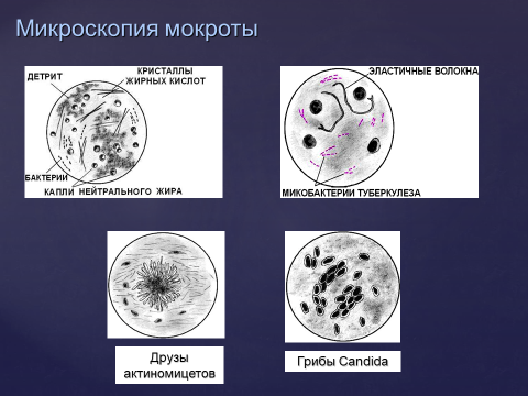 Мокрота на атипичные клетки подготовка. Кристаллы в мокроте микроскопия. Микроскопия мокроты при различных заболеваниях. Клеточные элементы мокроты. Микроскопия мокроты люминесцентным методом.