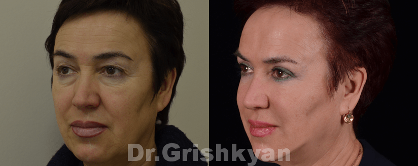Подтяжка лица SMAS фото до и после. Фото с сайта Д.Р. Гришкяна. Имеются противопоказания, требуется консультация специалиста