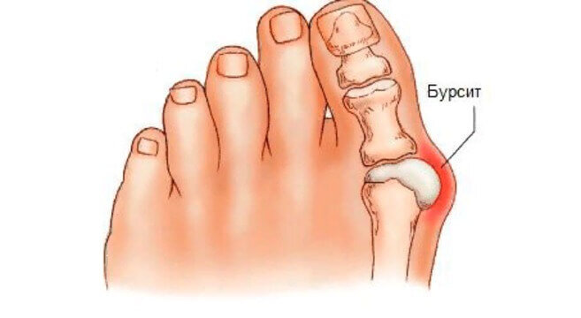 Болит большой палец на ноге
