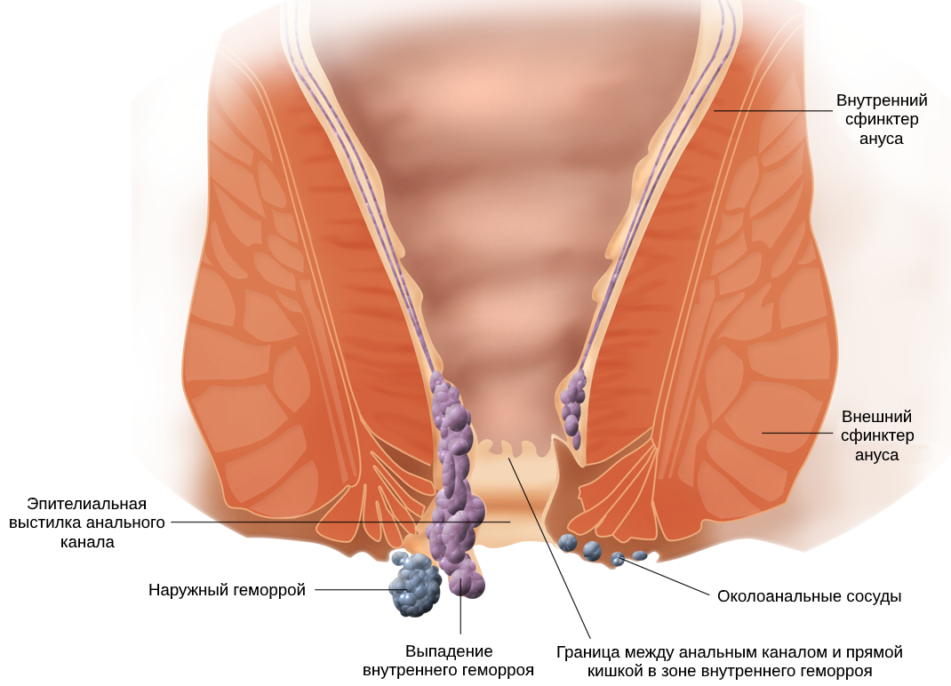 Лечение геморроя в домашних условиях: как снять воспаление и боль