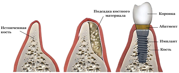 Как выглядит атрофия, подсадка и уже имплант после установленный в наращенную костную ткань 