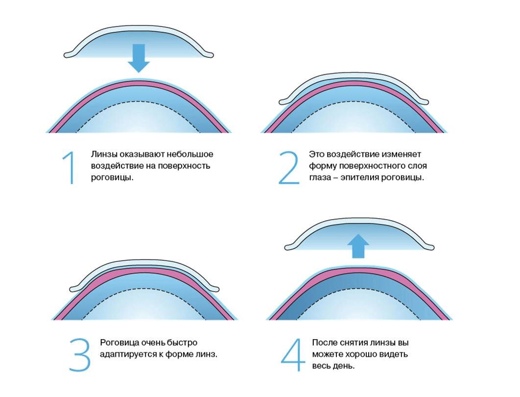 Схема работы ортокератологической линзы