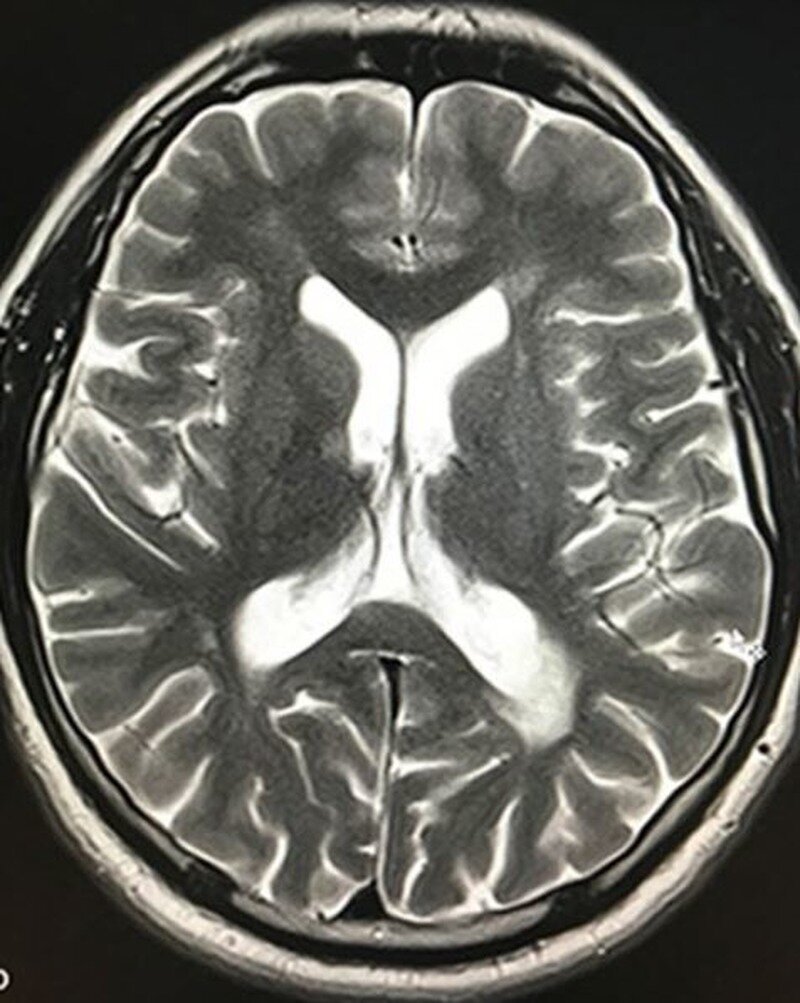 МРТ головного мозга