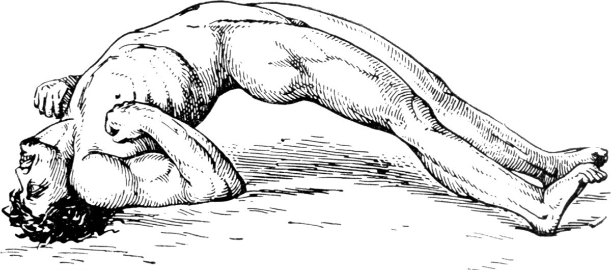 Состояние опистотонуса