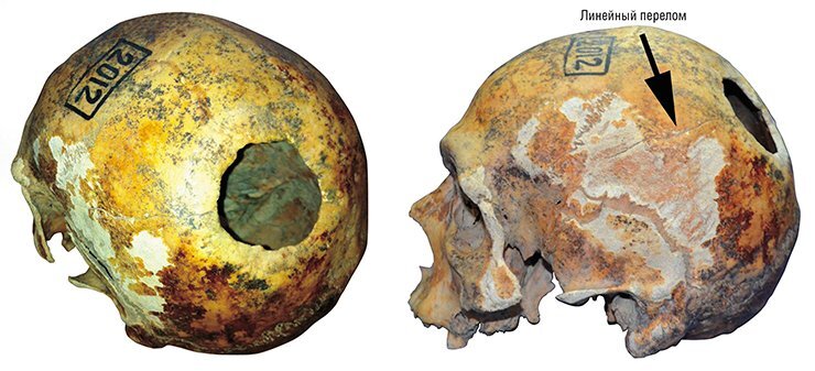 На черепе мужчины из кургана 3 курганной группы Кызыл-Джар–V обнаружено трепанационное отверстие диаметром около 6 см, а также следы успешно залеченного линейного перелома костей. Томский государственный университет