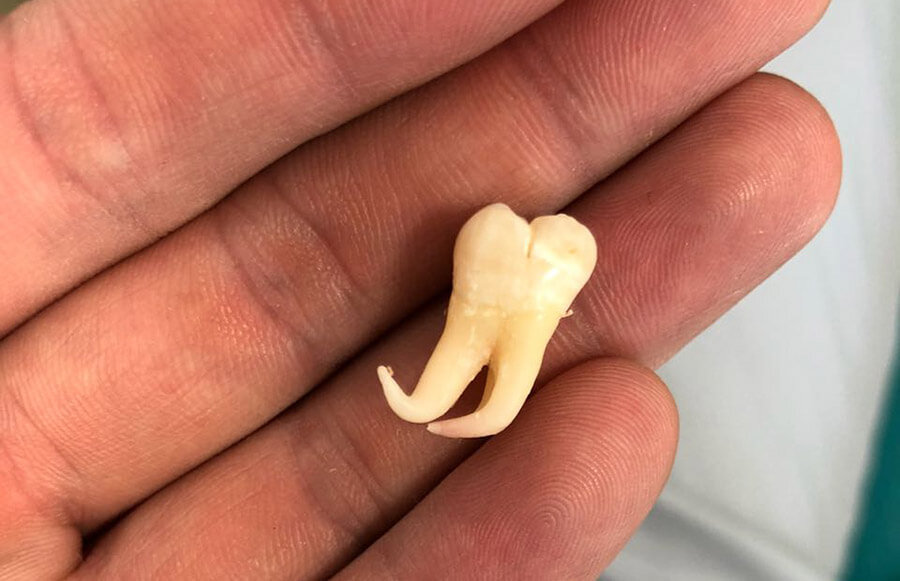 Зуб мудрости с изогнутыми корнями