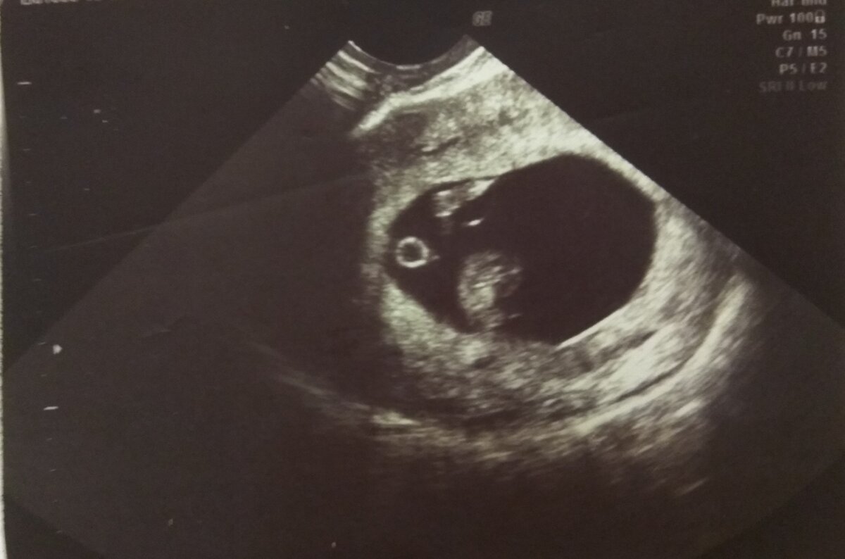 Двойня 8 недель беременности фото узи