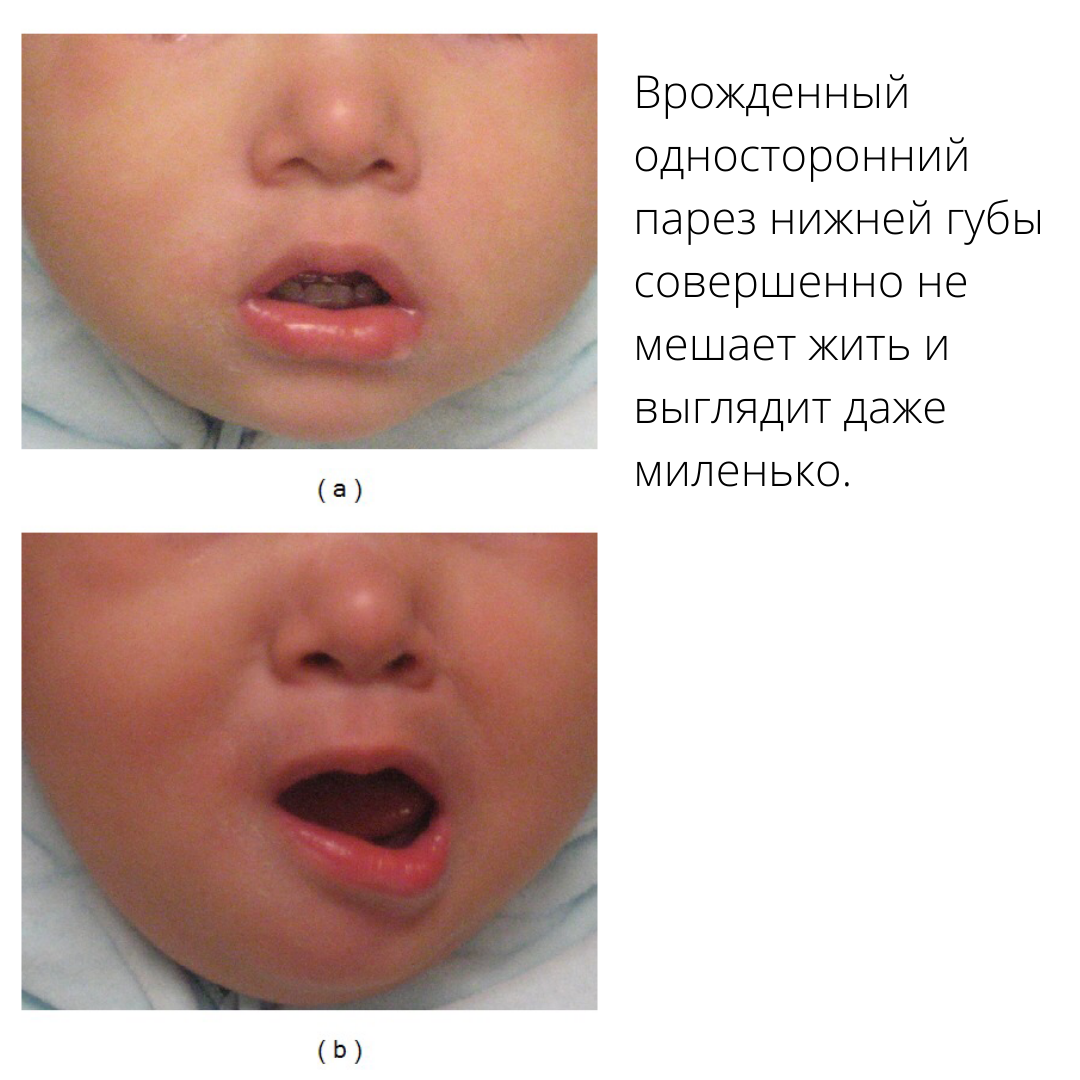 Сглаживание носогубной складки симптом какой болезни?