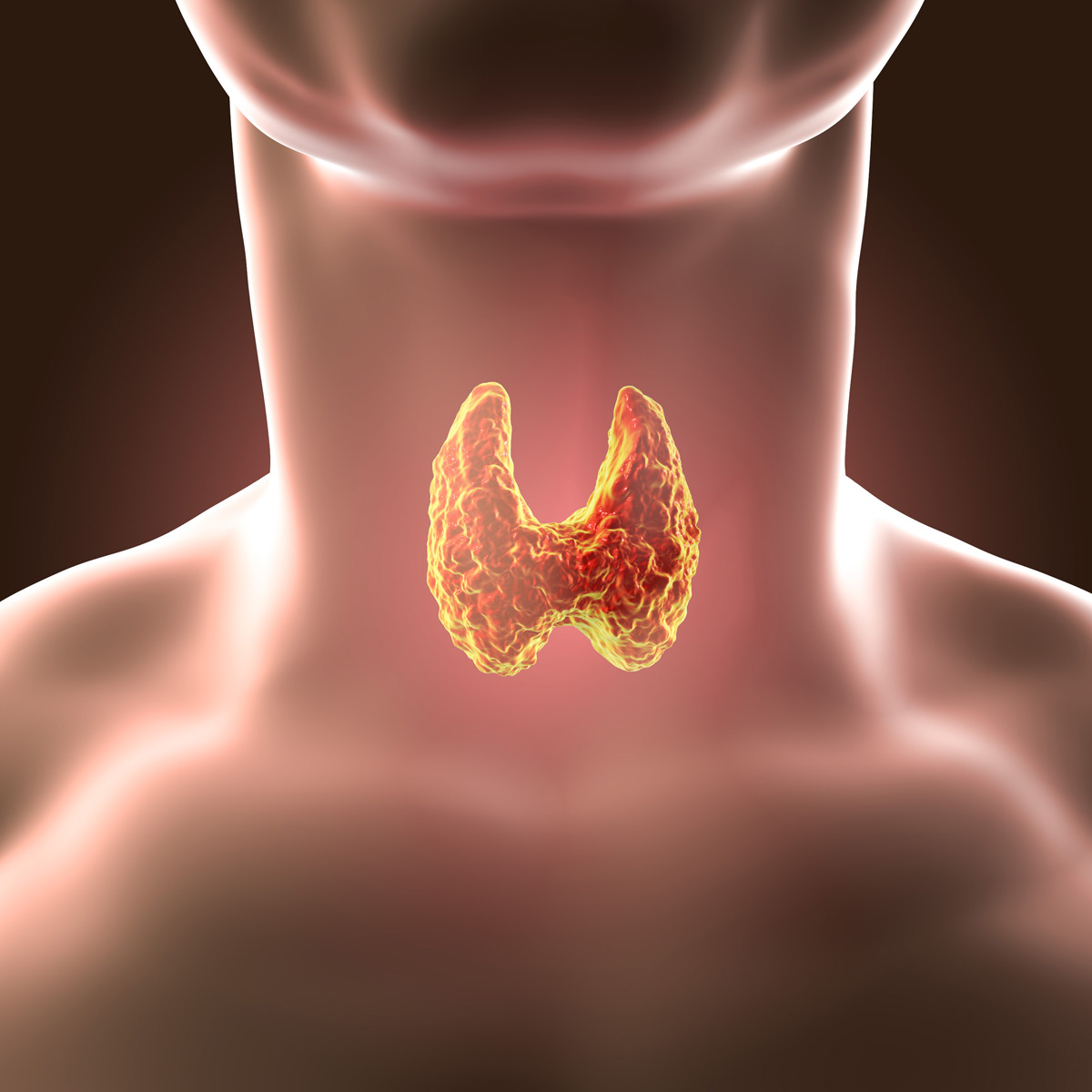щитовидная железа рак фото