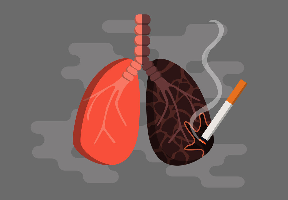 Восстановятся ли легкие, если бросить курить? Отвечает нарколог | Клиника  доктора Шурова | Дзен