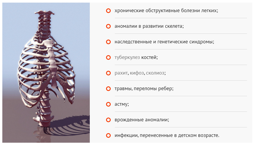 Причины деформации ребер