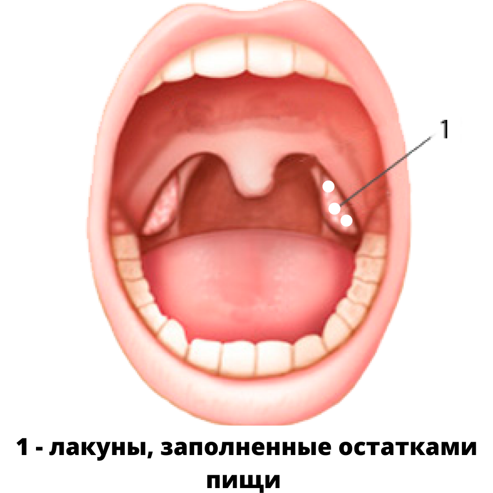 Хронический тонзиллит или как избавиться от пробок в миндалинах | Здоровая  нация | Дзен